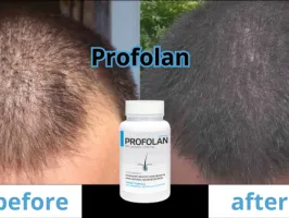 Profolan - Łysienie